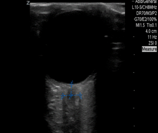 Thumbnail image for Convulsión Focal y el Uso del Diámetro de la Vaina del Nervio Óptico