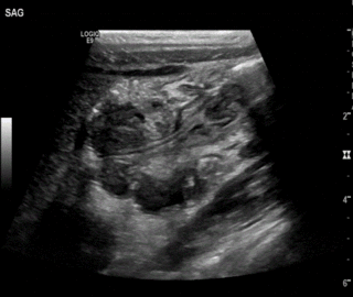 Cover of Ultrasound-guided Reduction of Intussusception
