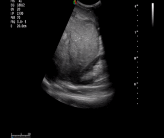 Thumbnail image for Biopsie Hépatique Dans le Carcinome Hépatocellulaire