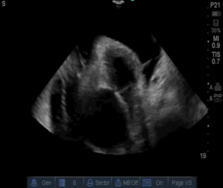 Thumbnail image for Fibrosis Endomiocárdica Tropical