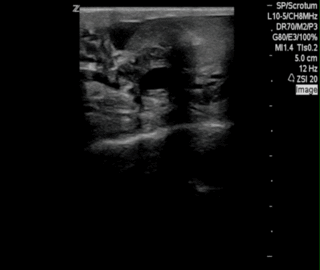 Thumbnail image for Lymphatic Filariasis
