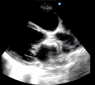 Thumbnail image for Peripartum Cardiomyopathy