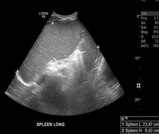 Thumbnail image for Hyper-reactive Malarial Splenomegaly