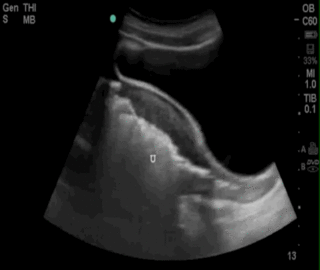 Thumbnail image for Necrotizing Endomyometritis
