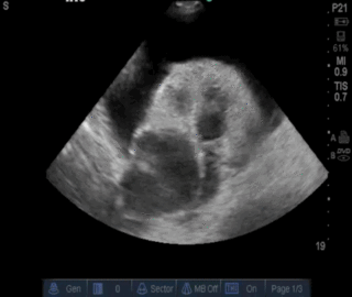 Thumbnail image for Tropical Endomyocardial Fibrosis